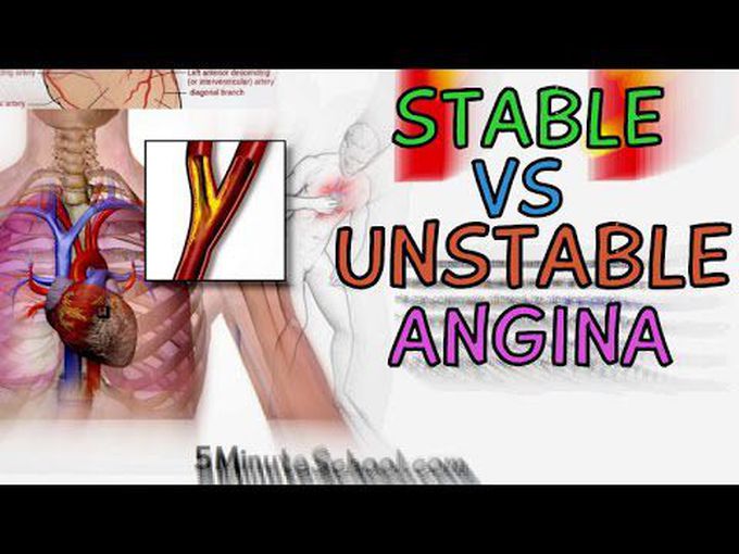 Difference between stable and unstable Angina