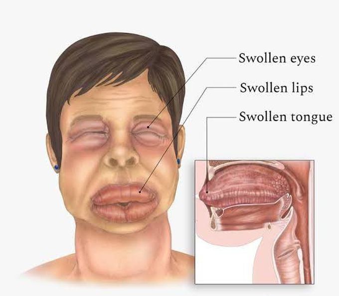 Angioedema