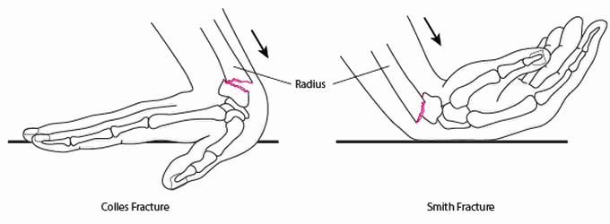 Colles vs Smith Fracture