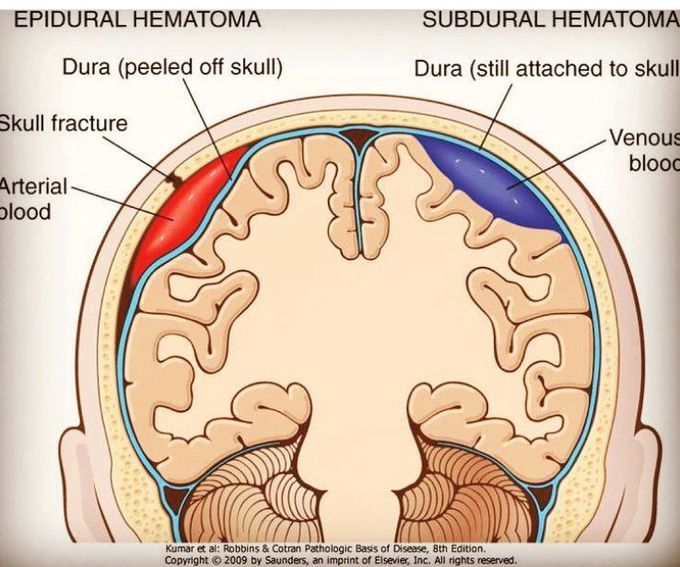 epidural hematoma vs subdural hematoma