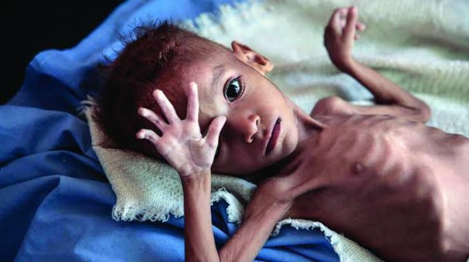 Symptoms of malnutrition