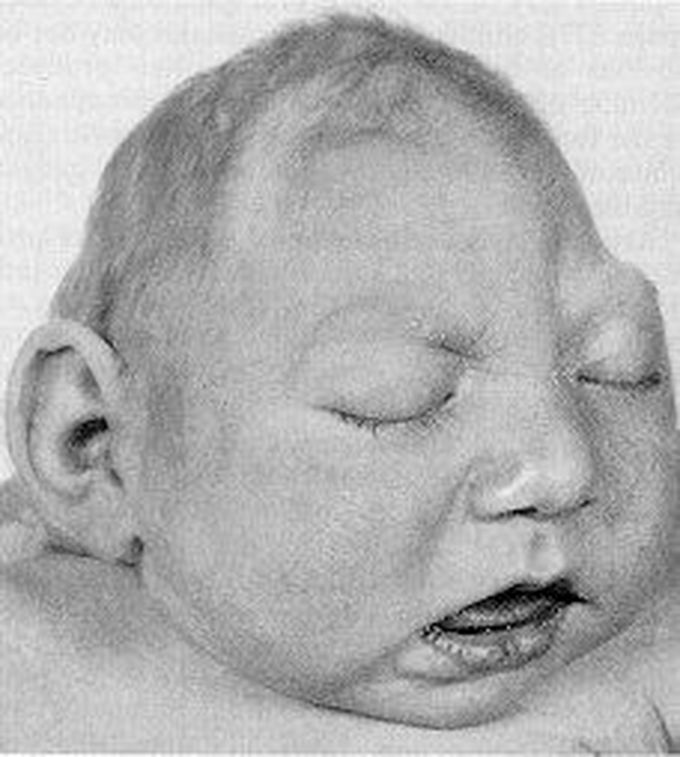 Microcephaly