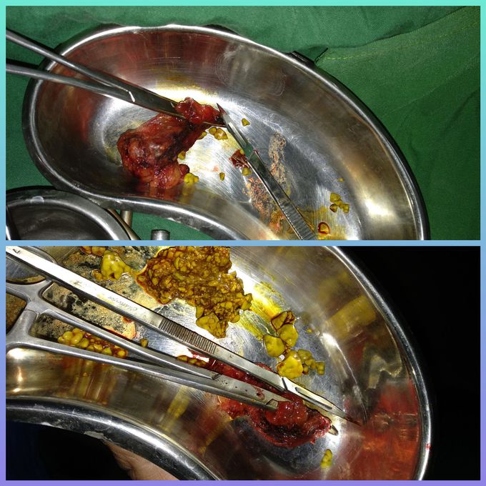 Gallstones after cholesystectomy