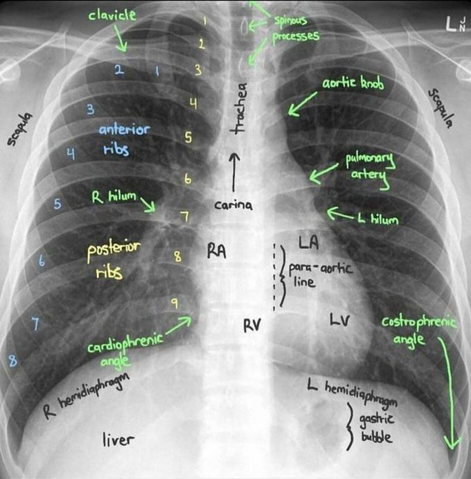 Normal Chest X-ray
