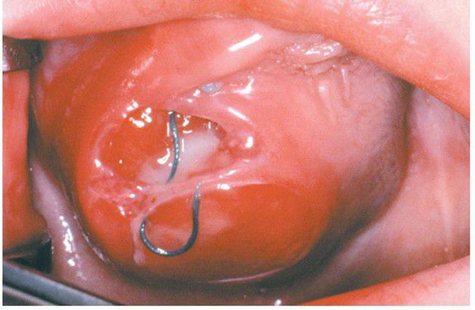 Fibrosarcoma