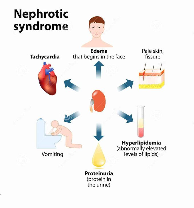 Nephrotic syndrome.