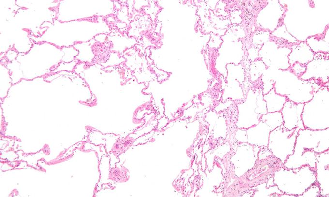 Autoimmunity plays role in development of COPD, study finds