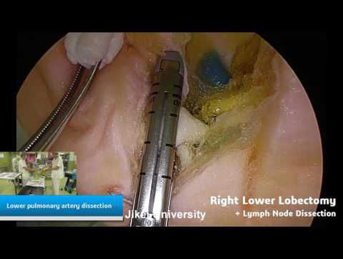 Simulation of VATS Lobectomy Using a Lifelike Chest Model
