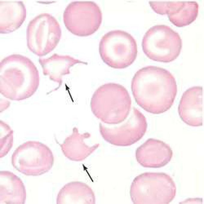 Diagnosis this cell? This is blood film . But the cell is present in the hematuria too. When do stain for urine ?