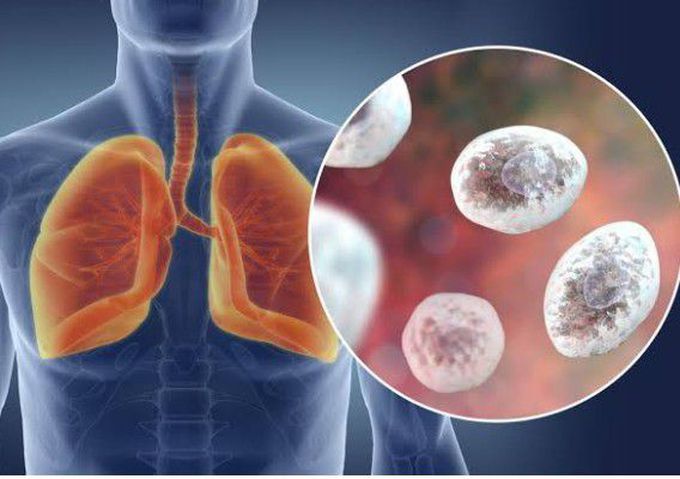 Cause of Pneumocystis pneumonia