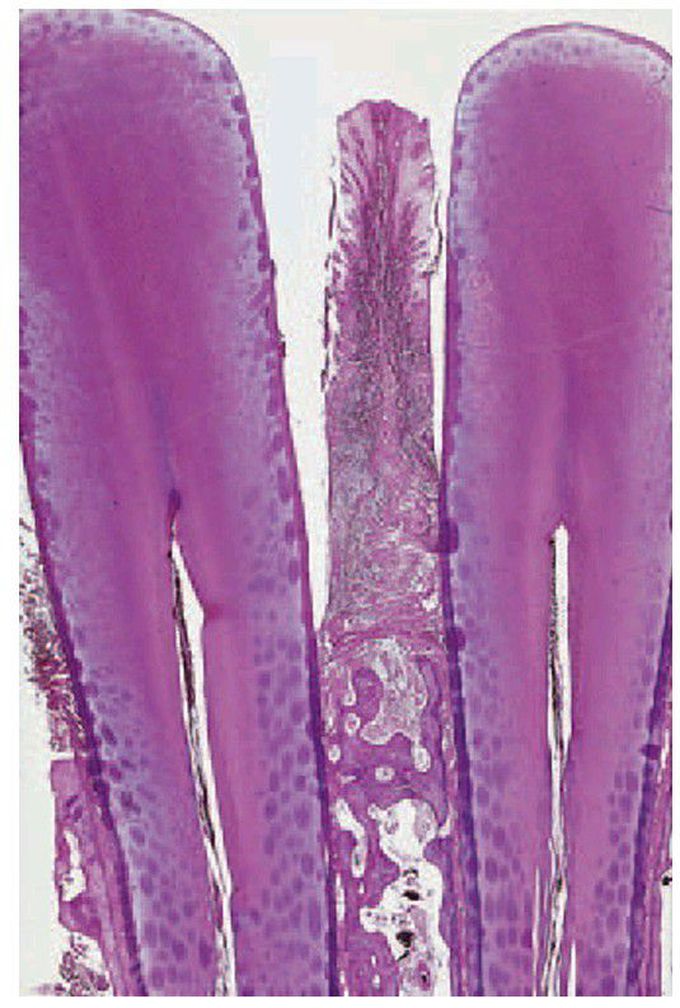 Established chronic periodontitis