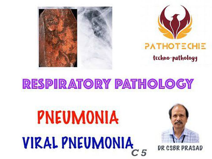 Overview of Viral pneumonia