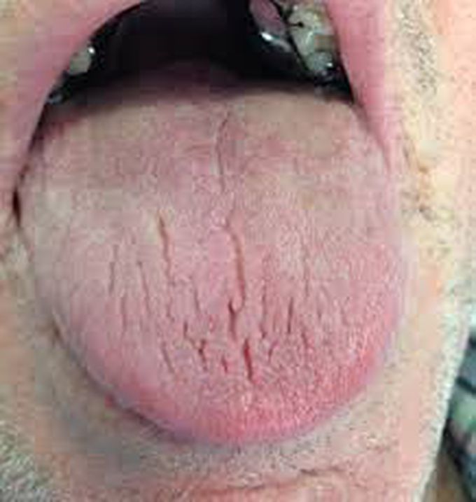 Complications of xerostomia