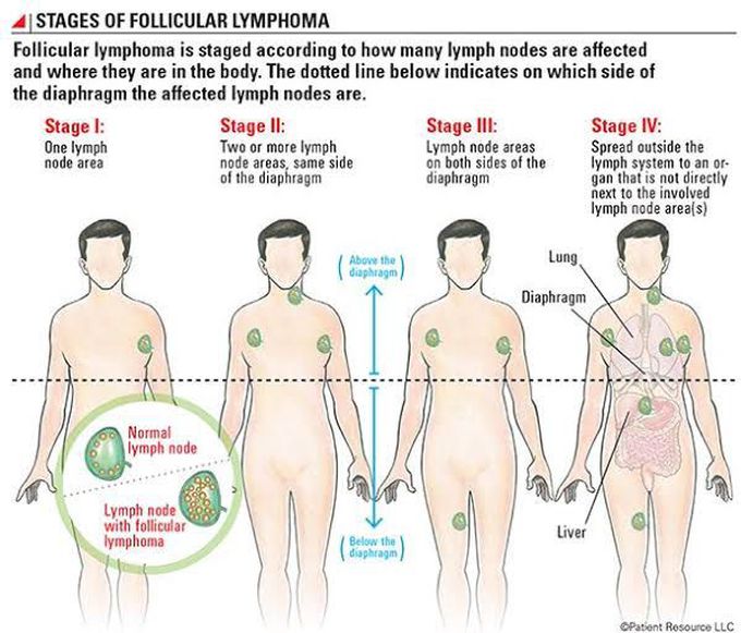 Stages of Follicular Lymphoma