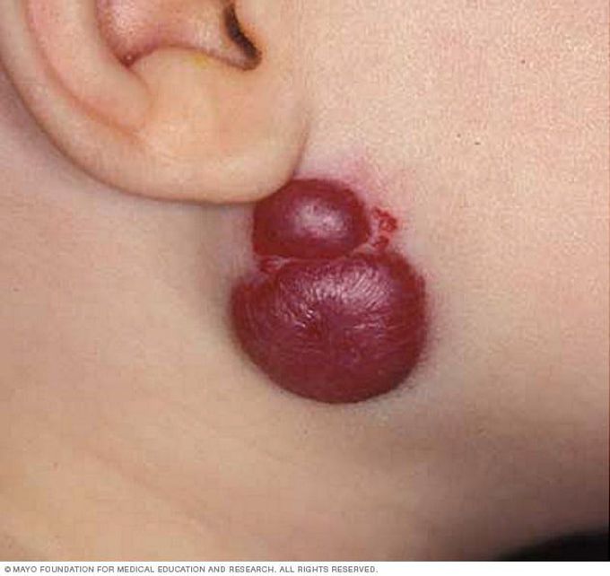 Types of Hemangioma