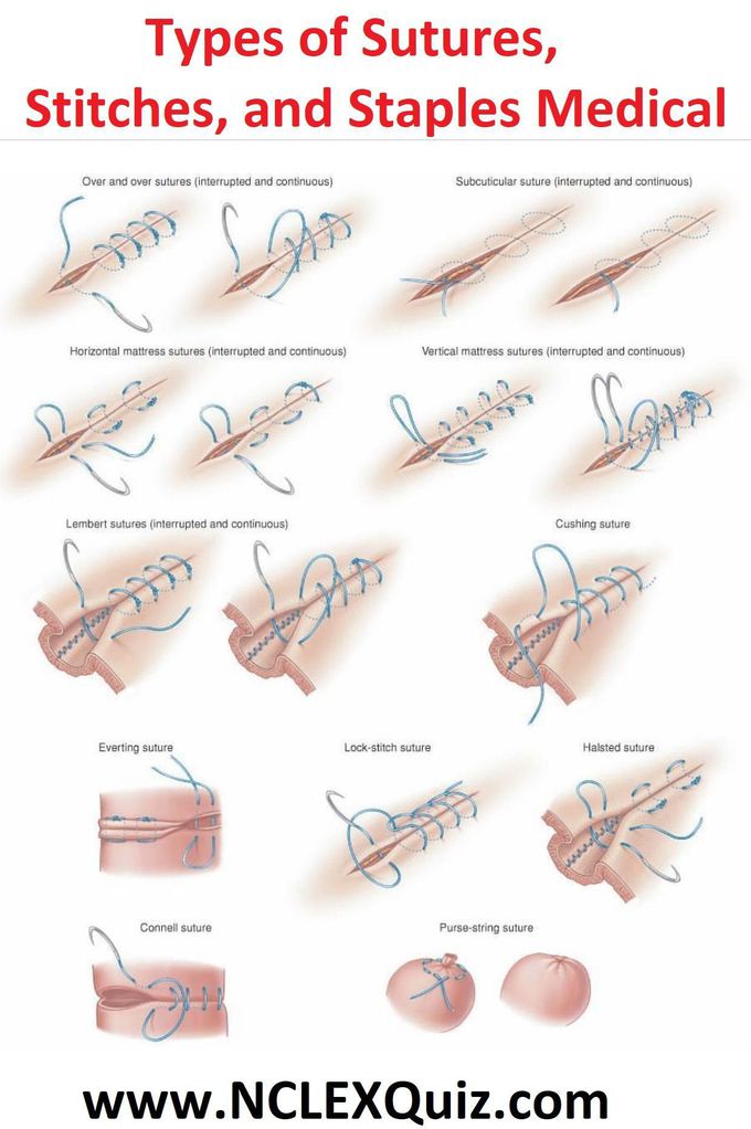 Sutures Type