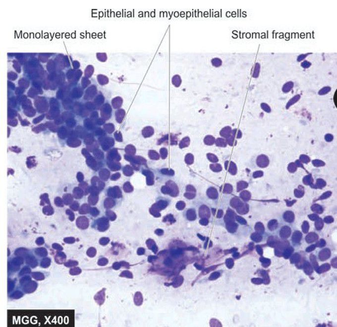 Fibroadenoma