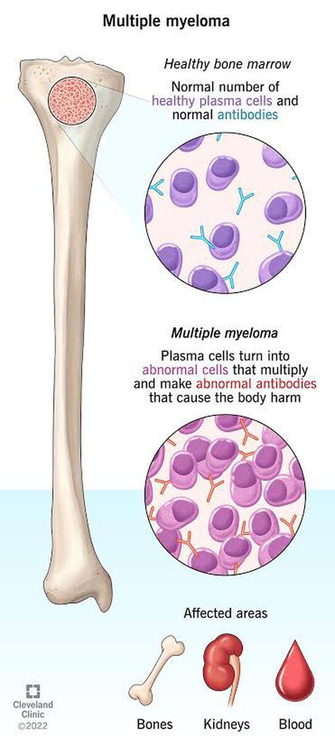 Symptoms of multiple myeloma