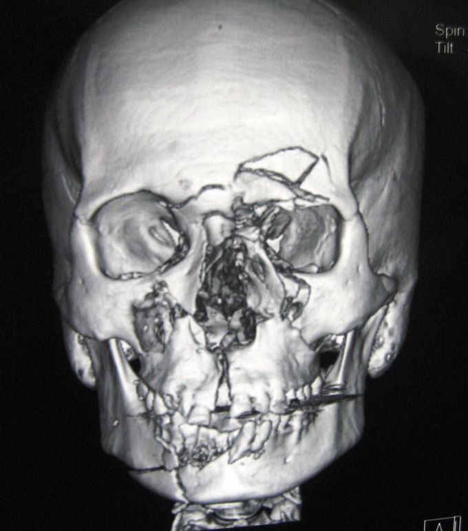 Case sequence (maxillofacialsurgery)