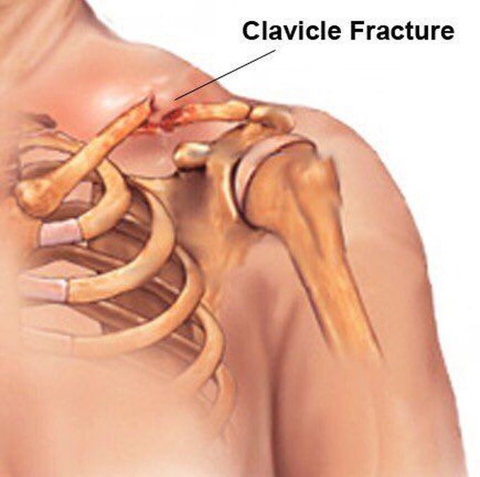 Clavicle fracture