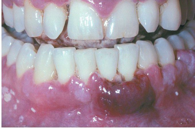 HIV-associated Kaposi Sarcoma (KS).