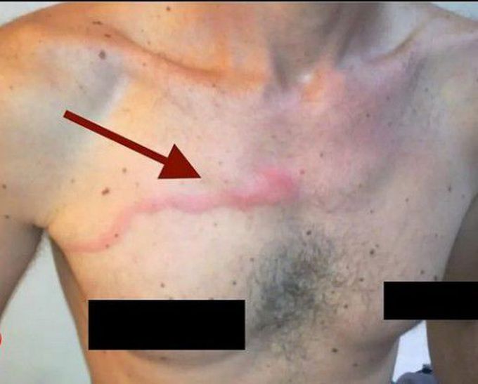 Mondor's disease