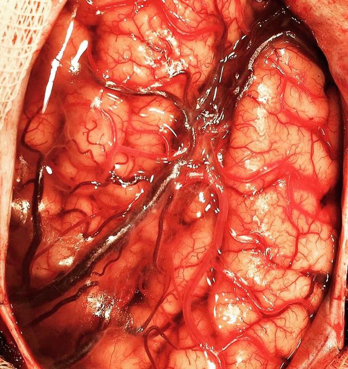 Brain inside