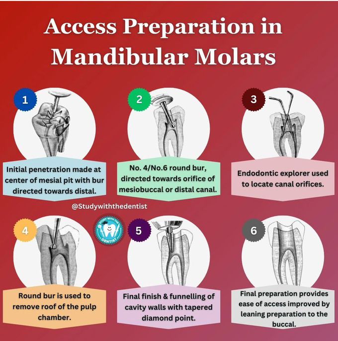 Access Cavity in Molars