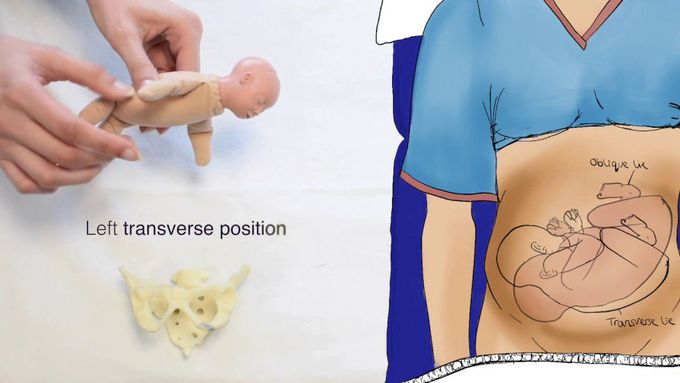Types of Fetal Positions - OSCE Guide