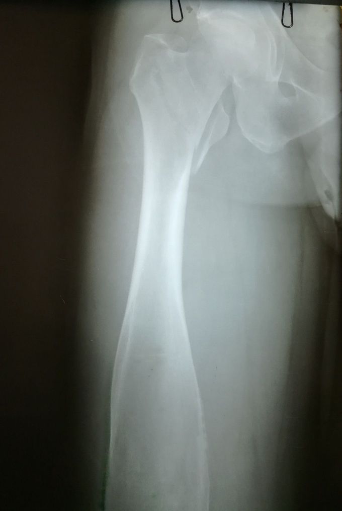 What is the reason for enlargement of the femur shaft? Is it a tumor?