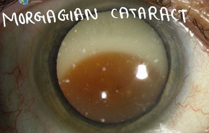Morgagnian Cataract