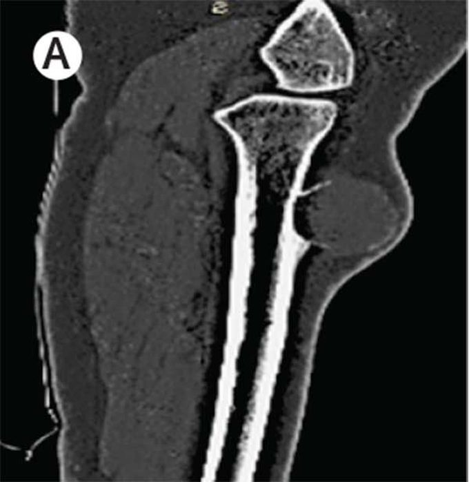 Tender palpable mass on leg of diabetes patient