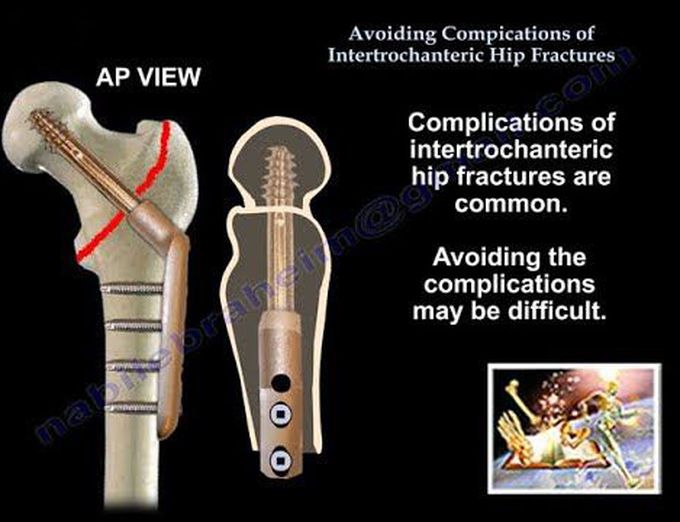 Avoiding Complications Intertroch.  Hip Fractures - Everything You Need To Know - Dr. Nabil Ebraheim