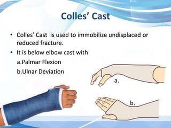 Colle's Cast