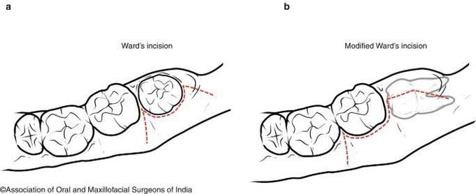 Wards Vs Modified Wards Incision