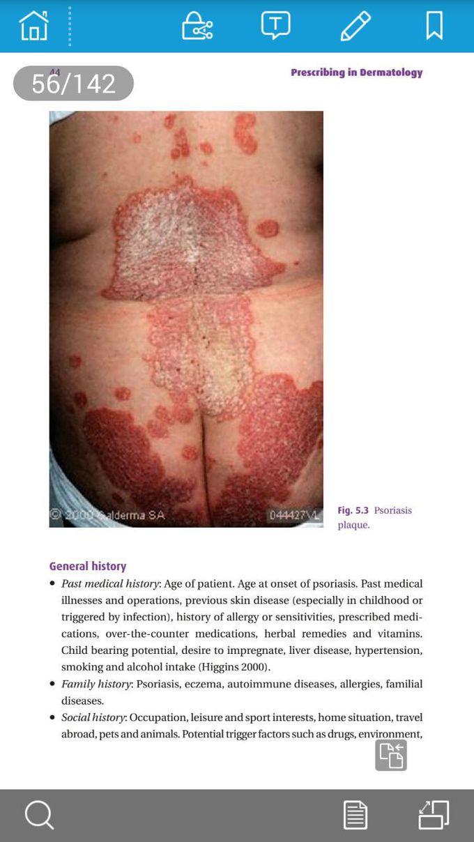 Psoriasis