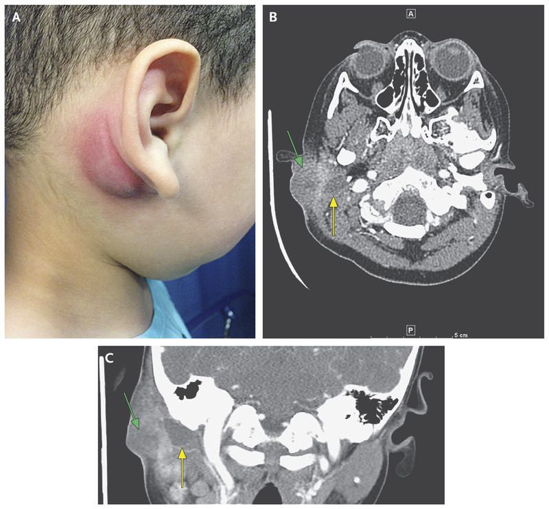 First Branchial Cleft Cyst Medizzy