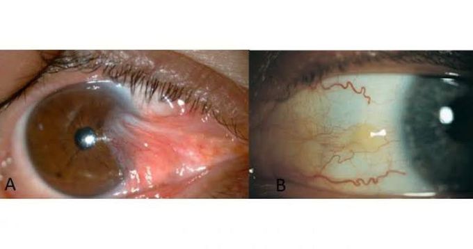 UV rays don't spare the eye- Pterygium vs Pinguecula