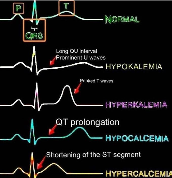 ECG Alteration