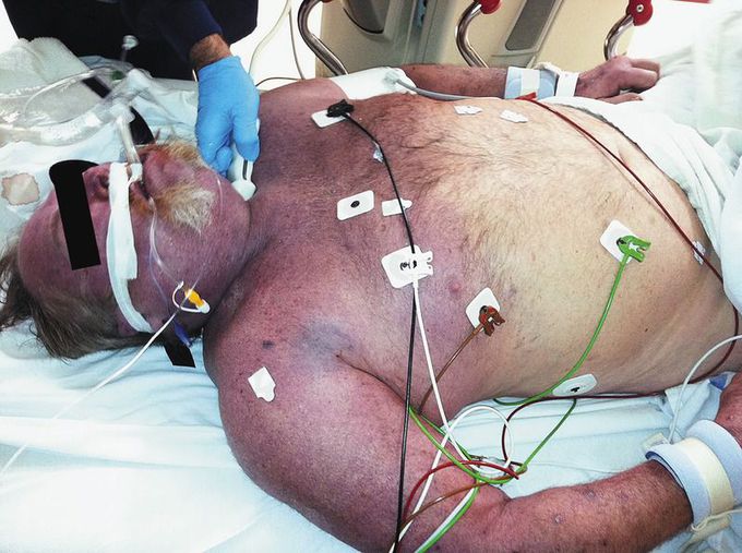 Superior Vena Cava Syndrome