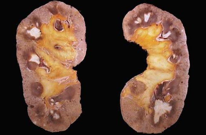 Symptoms of renal papillary necrosis