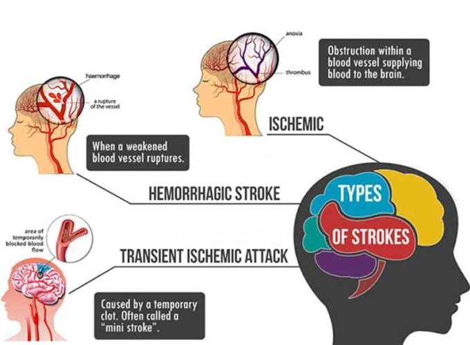 Types of Stroke