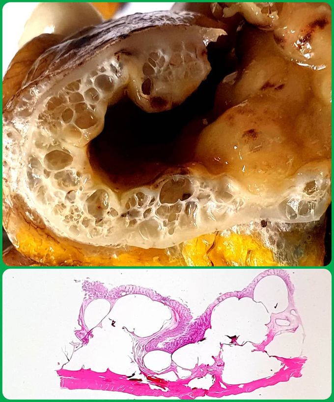 Pneumatosis cystoides intestinalis