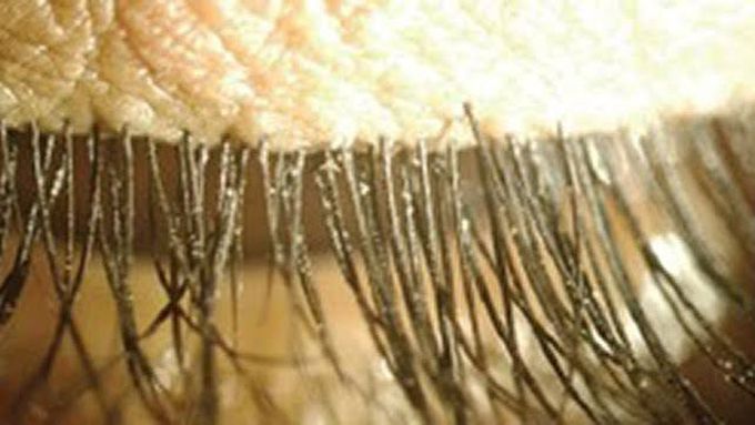 Demodex Folliculorum