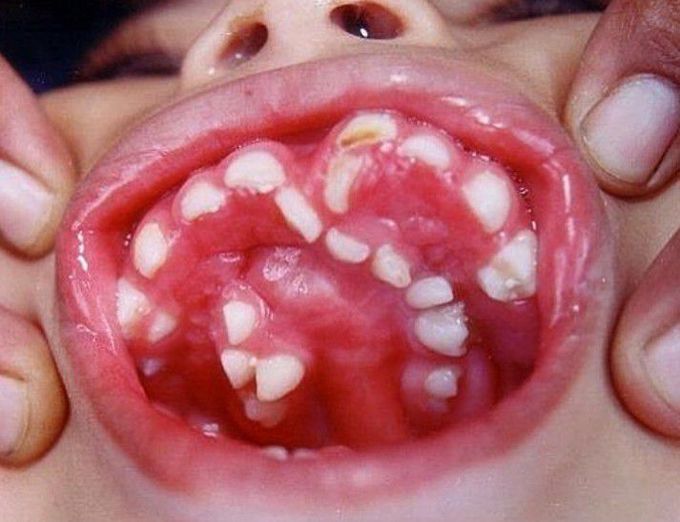 Hyperdontia