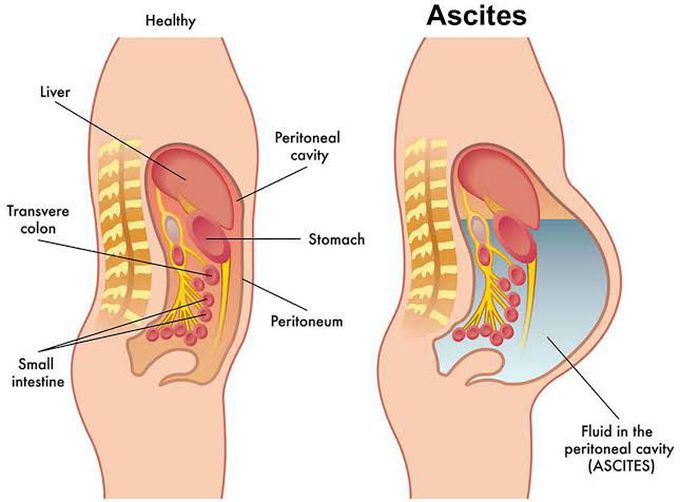 Causes of Ascites