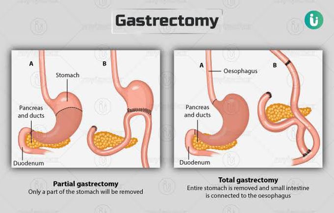 Gastrectomy