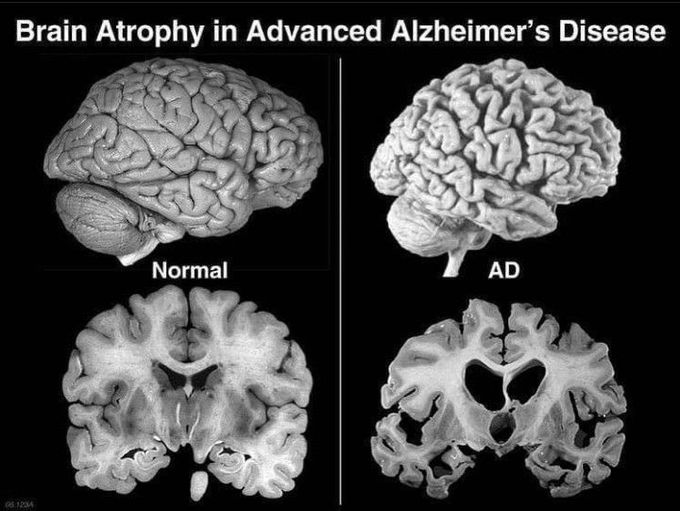 Alzheimer's disease