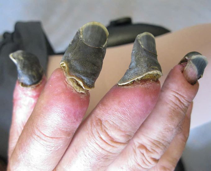 Case of gangrene of the fingers after septic shock and DIC that involved the use of vasopressors.