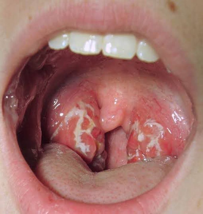 Infectious mononucleosis